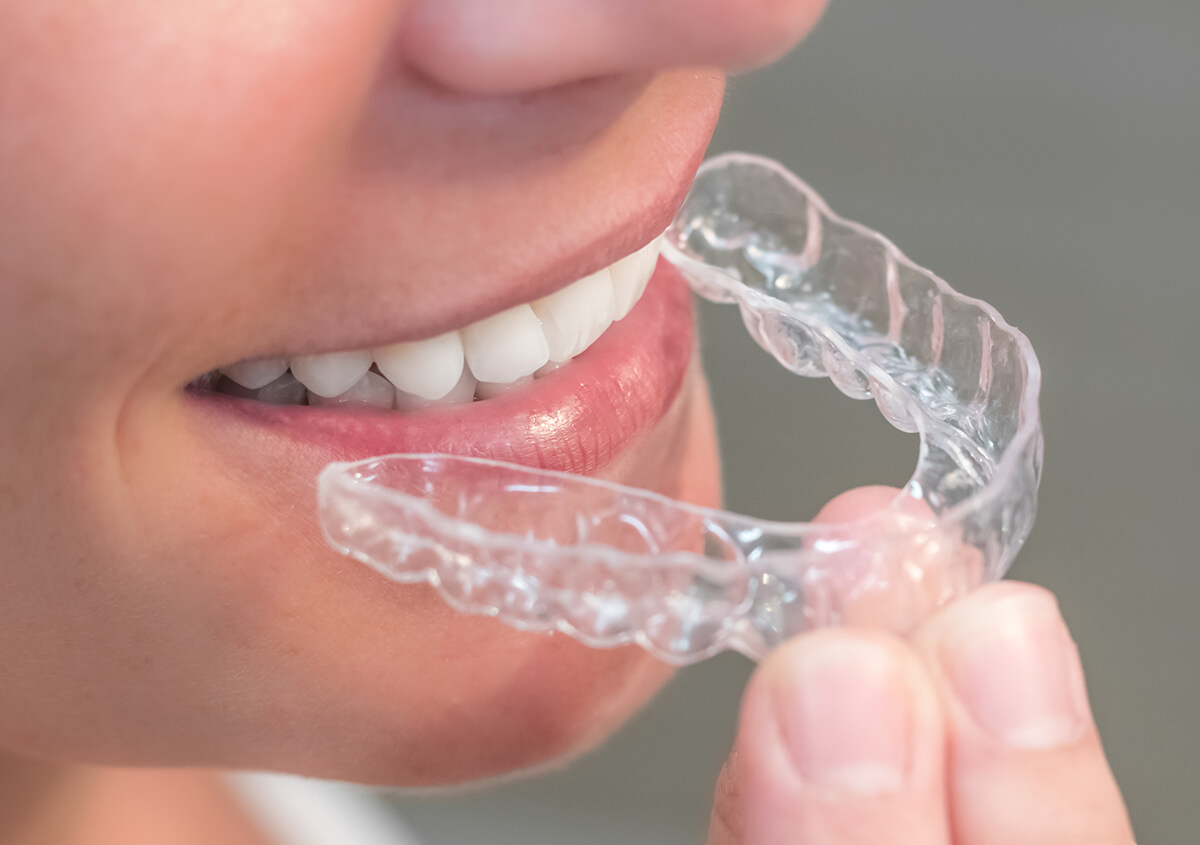 Lasting Invisible Teeth Aligners In Sunnyvale Ca
